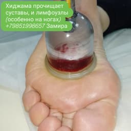 Хиджама, сулук, массаж