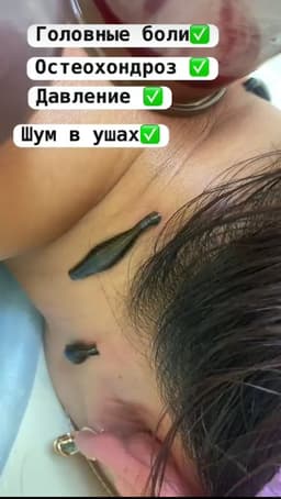 Хиджама массаж пиявки